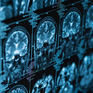 Atypische Parkinson-Syndrome - Die Multisystematrophie