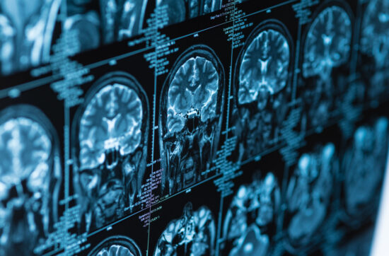 Atypische Parkinson-Syndrome - Die Multisystematrophie