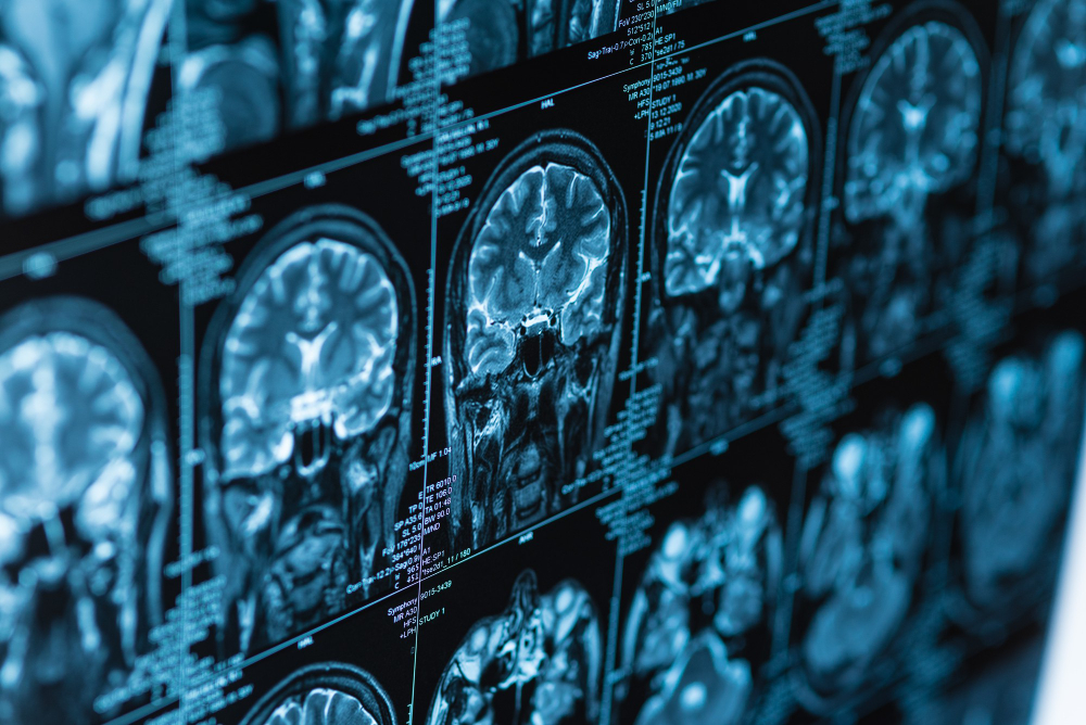 Atypische Parkinson-Syndrome - Die Multisystematrophie