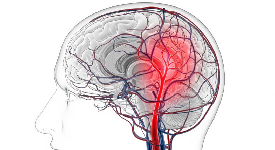 Hirnaneurysma: 8 Warnsignale, die Sie niemals ignorieren sollten