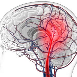 Hirnaneurysma: 8 Warnsignale, die Sie niemals ignorieren sollten